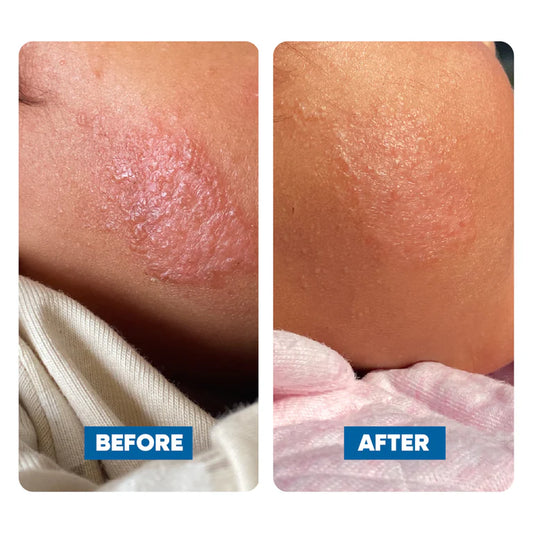 MooGoo - Psoriasis & Eczema Cream Marshmallow & Elderberry 120g
