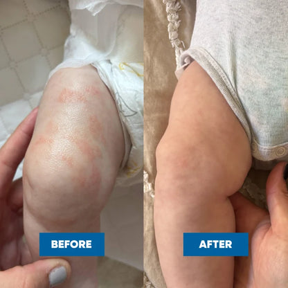 MooGoo - Pink Eczema Cream 120g