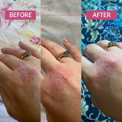 MooGoo - Pink Eczema Cream 120g